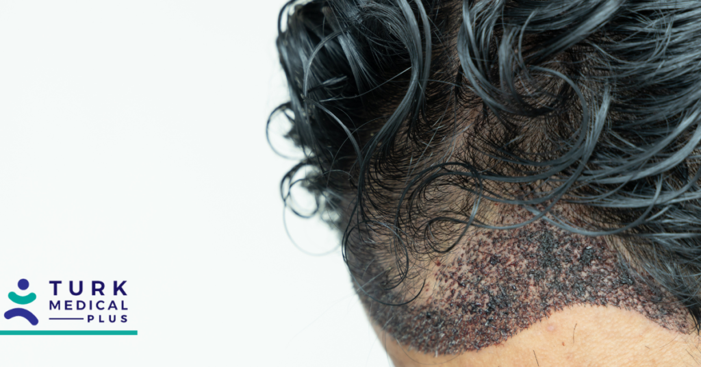 زراعة الشعر بتقنية نقل الشعر الشريطي (FUT)